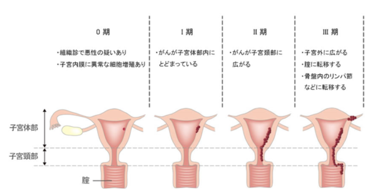 腺子宮頸内細胞