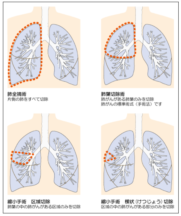 肺がんとは 北青山dクリニック